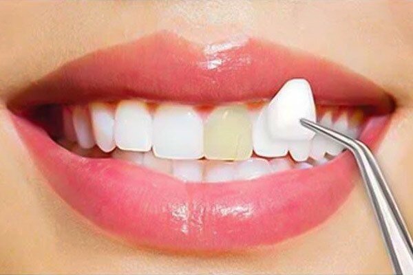 مزایا و معایب لمینت دندان: هزینه، دوام و نتایج قبل و بعد