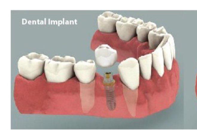 ایمپلنت دندان