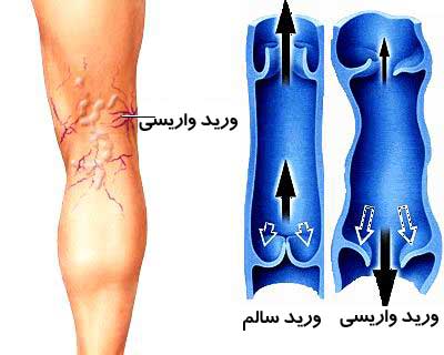 جوراب واریس چیست و چه تاثیری دارد؟