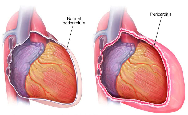 همه چیز در مورد پریکاردیت یا التهاب پرده دور قلب