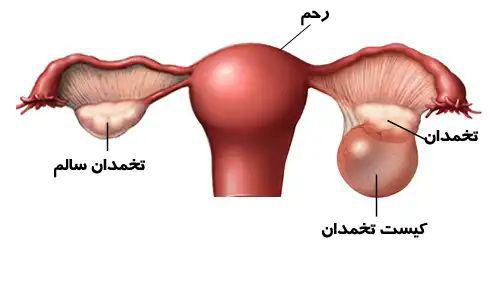 درمان اندومتریوز