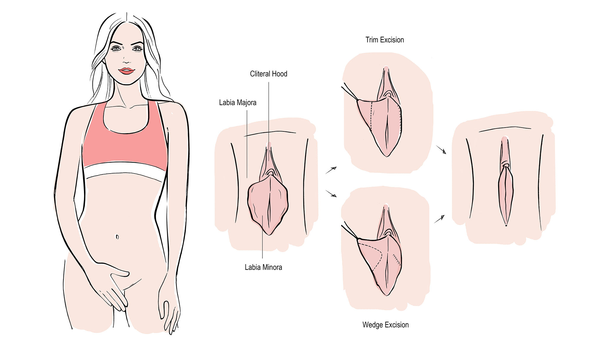 labiaplasty