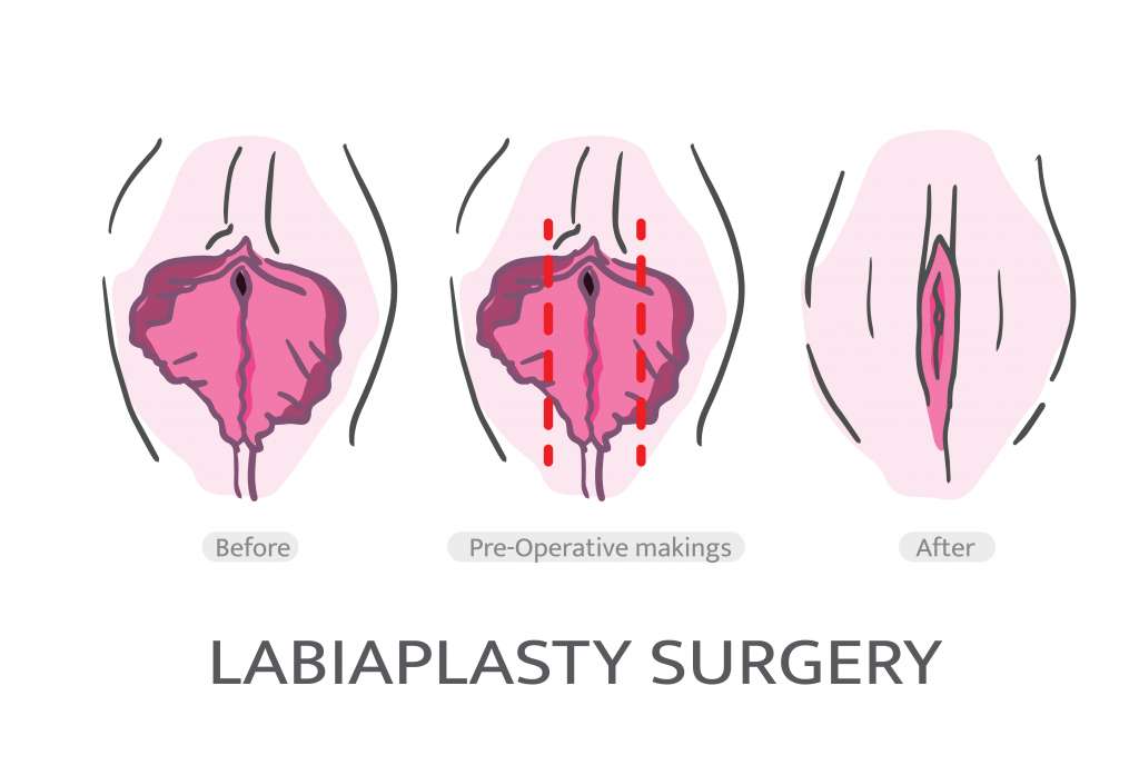شکل جراحی زیبایی واژن