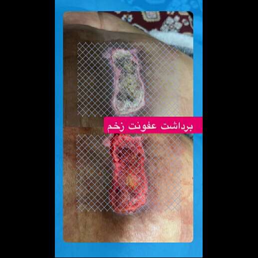 تصویر 1 آیدا علیزاده درمانگر زخم