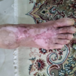 تصویر 3 کلینیک زخم حاکا