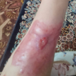 تصویر 9  درمانگر تخصصی زخم و سوختگی میلاد نوروزیان