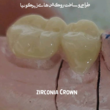 تصویر 1 دندانسازی مهر
