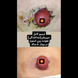 تصویر 2 هیوا سعیدی کارشناس تخصصی زخم و استومی