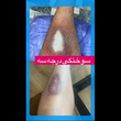 تصویر 2 آیدا علیزاده درمانگر زخم