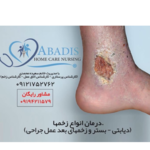 درمان زخم آبادیس