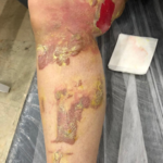 کلینیک زخم حاکا