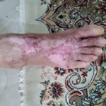 کلینیک زخم حاکا