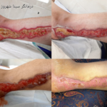 درمانگاه زخم اقاقیا