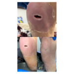 کارشناش زخم و  استوما سجاد فروزان مهر