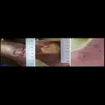 سهیلا اسماعیلی درمانگر زخم