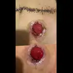 هیوا سعیدی کارشناس تخصصی زخم و استومی