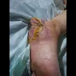 درمانگر زخم و استوما علیرضا علیپور 