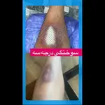 آیدا علیزاده درمانگر زخم